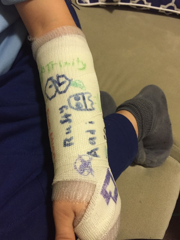 The broken wrist - day 2